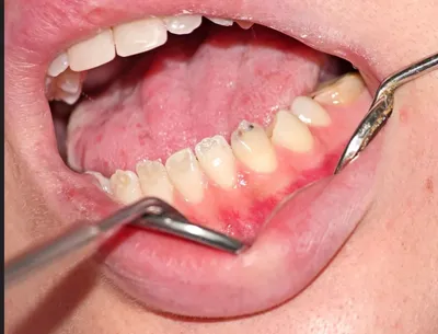 Кариес дентина зубов - причины, стадии, жалобы, симптомы, диагностика,  лечение