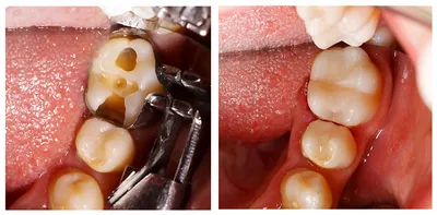 Виды кариеса и как выглядит кариес на зубах и на рентгене - реальные фото