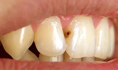 COViD-19 и кариес зубов