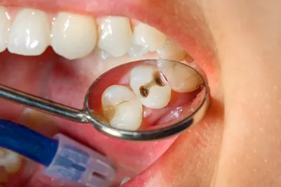 Качественное лечение кариеса зубов: цены, отзывы, фото До и после