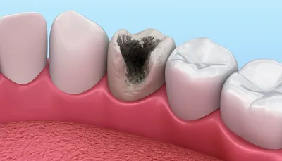 Лечение глубокого кариеса зубов с помощью лечебных прокладок на дентин,  фото, цены