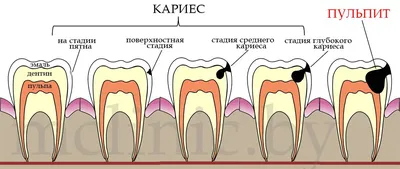Лечение кариеса зубов | 32 Дент Стоматология | Ачинск