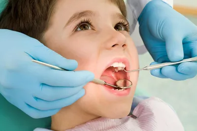 Кариес зубов: лечение, симптомы, причины возникновения и профилактика