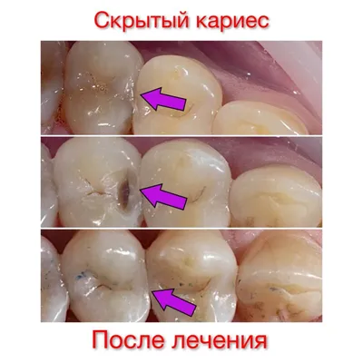 Своевременное лечение скрытого кариеса, обнаруженного по компьютерной  томографии зубов