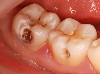 Вторичный кариес | Симптомы, лечение, профилактика | Клиника семейной  стоматологии Дока-Дент