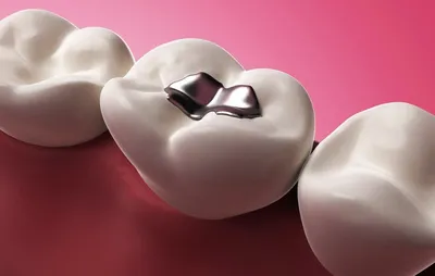 Лечение среднего и глубокого кариеса на жевательных зубах - Омега Стом
