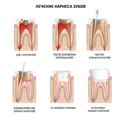 Ретроградный кариес: особенности, симптомы, лечение - энциклопедия  Ochkov.net