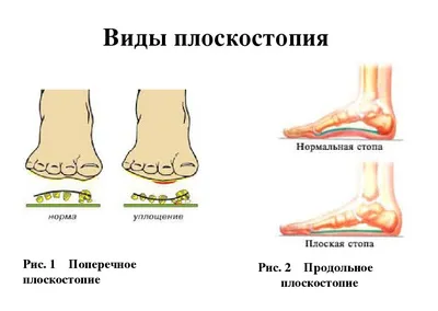 УПРАЖНЕНИЯ ПРИ СКОЛИОЗЕ И ПЛОСКОСТОПИИ