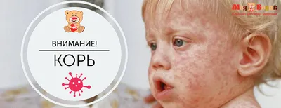 Корь: симптомы у взрослых и детей, профилактика, когда делать прививку:  Уход за собой: Забота о себе: Lenta.ru