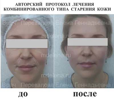 ТОП 3 инъекционных процедур у косметолога - ДРК