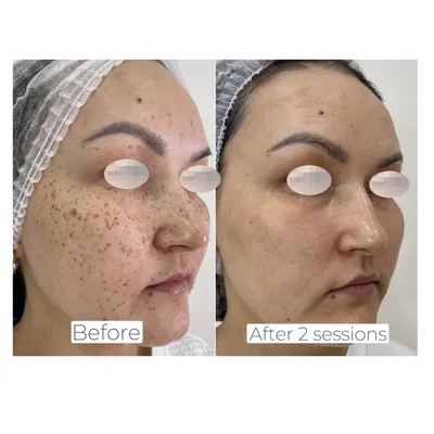 Фото до и после косметологических процедур | Клиника доктора Гришкяна