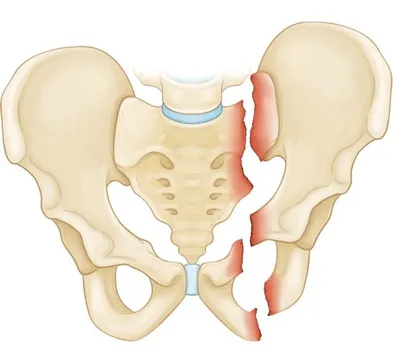 Перелом костей таза - признаки, причины, симптомы, лечение и профилактика -  iDoctor.kz