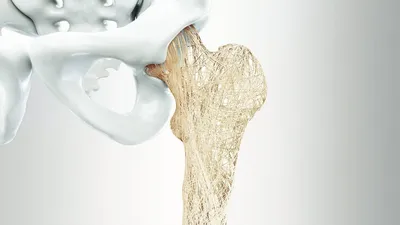 Остеосинтез в лечении переломов костей