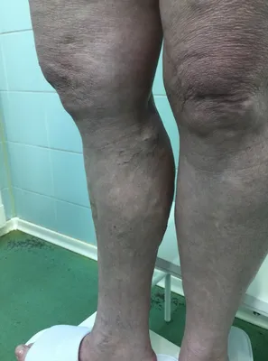Сухость ног | шелушение кожи на ногах - лечение в ММЦ ОН КЛИНИК в Москве