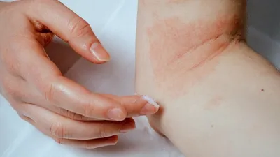 Шелушение кожи между пальцами ног: причины и способы лечения