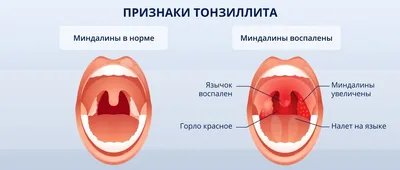 Спрей для горла детям: детский спрей от боли в горле: как применять при  ангине