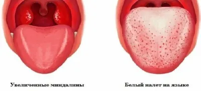 Родители часто спрашивают, как лечить красное горло ребенку. Сохраните  пост🚩 ⠀ Красное горло у ребенка – не диагноз, а симптом конкретной… |  Instagram