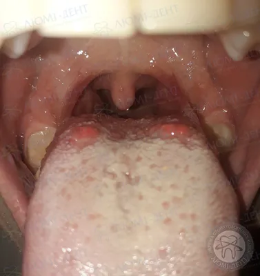 Болит ли горло при коронавирус?