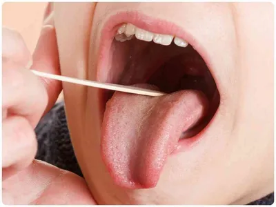 Как выглядит больное горло: правила осмотра и признаки заболеваний