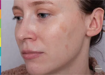 Лечение купероза на лице лазером: отзывы, фото | Beauty Insider