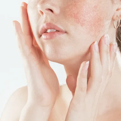 Лечение купероза на лице — самые эффективные варианты