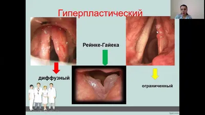 Фарингит, ларингит, трахеит, бронхит — как отличить болезни, вызывающие  кашель, друг от друга и чем их лечить