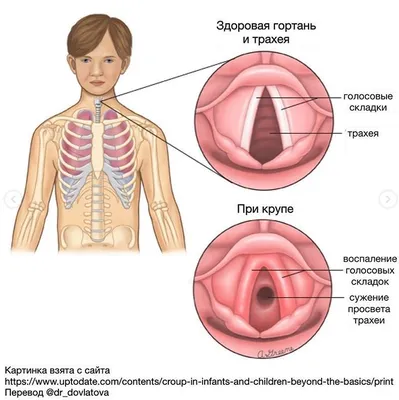 Хронический ларингит