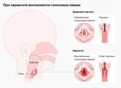 Что такое ларингит и чем его лечить - Лайфхакер