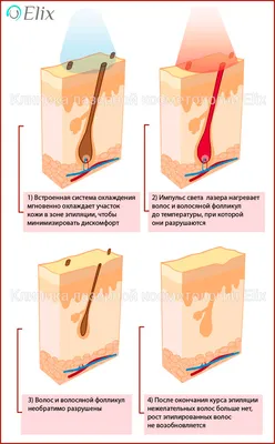 Лазерная эпиляция: все, что вы хотите знать – Клиника косметологии «Elix» в  Новосибирске