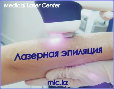Вызывает ли лазерная эпиляция рак кожи ✓Связь эпиляции и онкологии