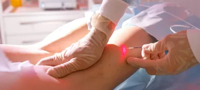Лазерное лечение грибка ногтей (онихомикоза) в Екатеринбурге
