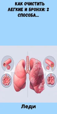 пневмония. легкие бронхи и трахея в рентген Иллюстрация вектора -  иллюстрации насчитывающей условие, орган: 241384679