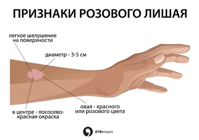 Опоясывающий лишай: симптомы, лечение, профилактика