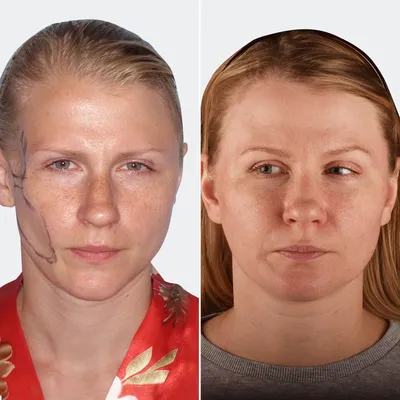 Лазерное отбеливание кожи: цена процедуры в Москве | Осветление кожи лица  лазером в клинике BeautyWay Clinic