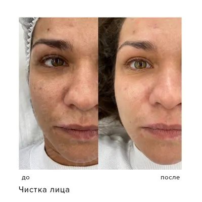 Серый цвет лица – лечение в медцентре «Номосклиник» | Стоимость процедуры в  Москве, отзывы, вопросы и ответы