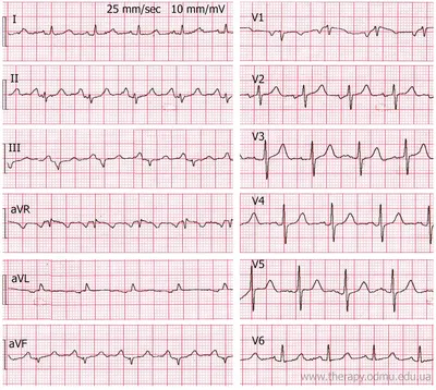 ЭКГ-диагностика гипертрофии левого предсердия