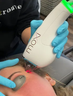 I Tried the Moxi Laser Treatment: See Photos | POPSUGAR Beauty