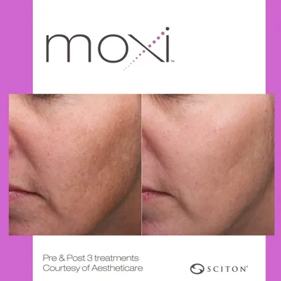 MOXI Laser Skin Rejuvenation Treatment in Largo, FL