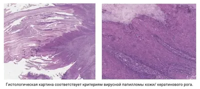 Лазерное удаление папилломы в Санкт-Петербурге недорого | Центр лазерной  эпиляции