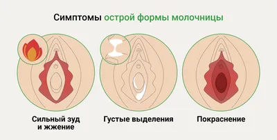 Молочница: симптомы, лечение, свечи