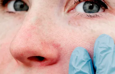 Прыщи на лице - причины появления, при каких заболеваниях возникает,  диагностика и способы лечения