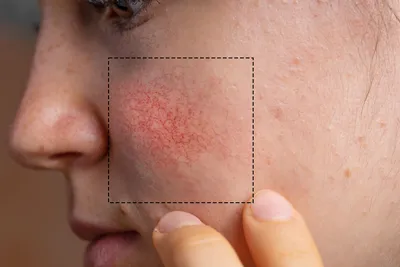Милиумы на лице: почему они появляются и как от них избавиться | Решение  проблем в клинике BeautyWay Clinic