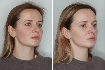 Как замаскировать сильные покраснения на лице? 3 этапа | Отзывы покупателей  | Косметиста