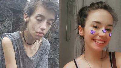 Бывшие наркоманы показали фото до и после того, как они завязали | Пикабу