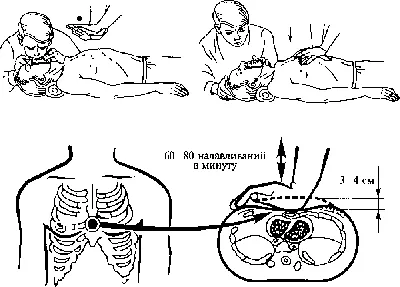 парамедик делает пациенту непрямой массаж сердца Иллюстрация вектора -  иллюстрации насчитывающей реаниматология, сердце: 216578550