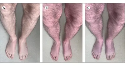Отеки ног: причины и лечение — медикаментозное лечение отечности нижних  конечностей