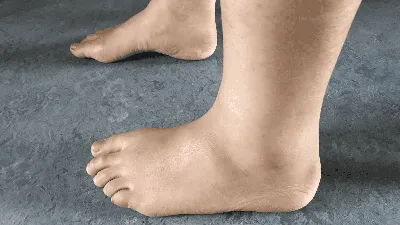 Что такое синдром беспокойных ног и как его лечить?
