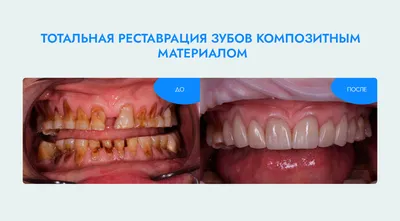 Зубы мудрости: зачем нужны, как и где растут, когда их нужно удалять, как  их лечить, стоимость