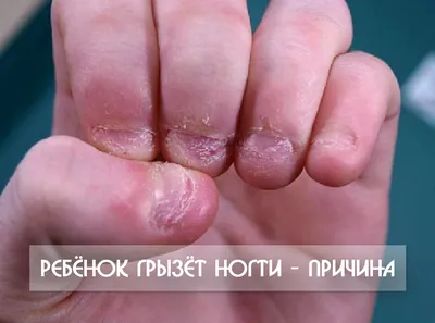 Ребёнок грызёт ногти – причина