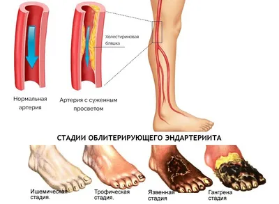 Облитерирующий эндартериит